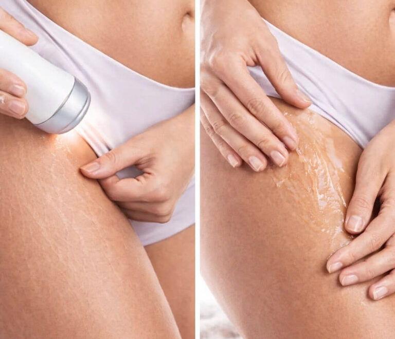 Θεραπεία για ραγάδες