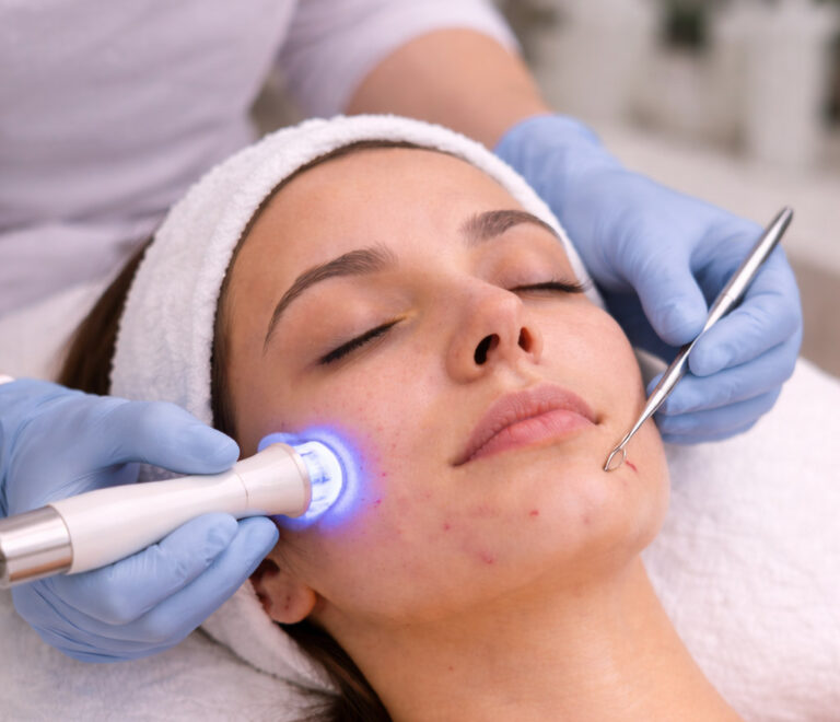 Αντιμετώπιση ακμής